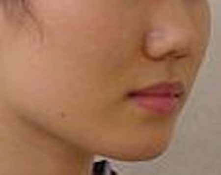 【矯正症例】ディープバイト、睡眠時無呼吸症候群が疑われた症例